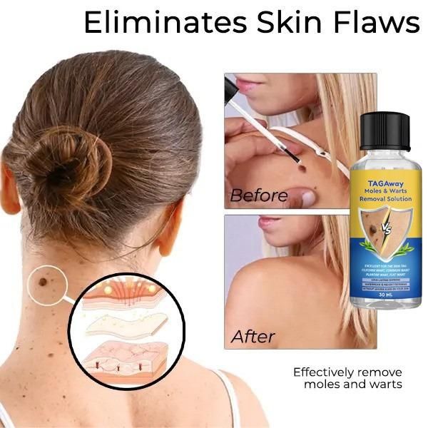 Moles and Warts Removal Solution 60 ML Pack of 2